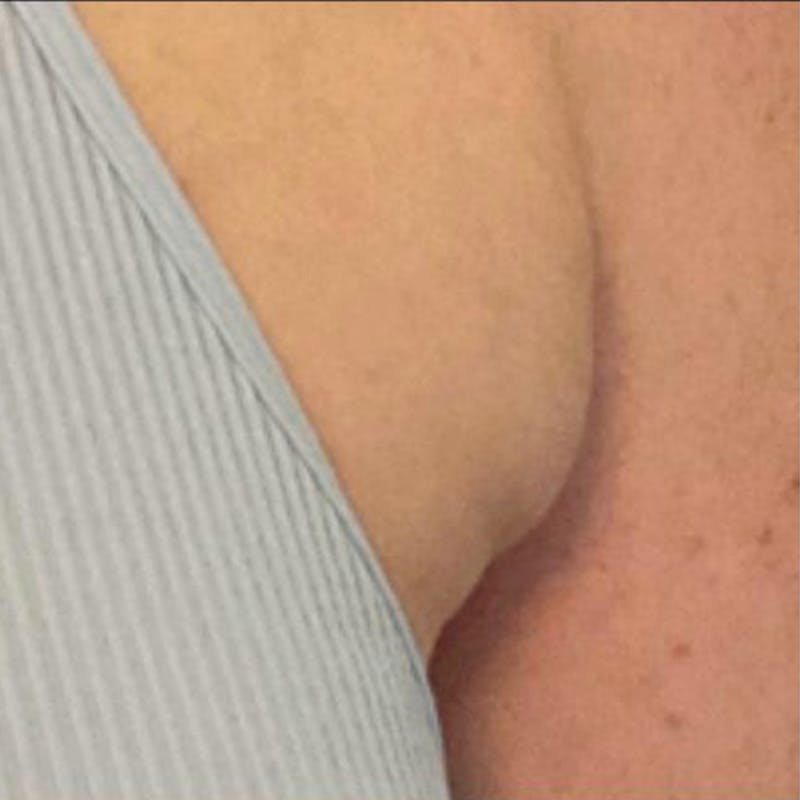 Junera Before & After Gallery - Patient 243355 - Image 1