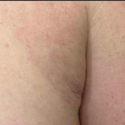 Junera Before & After Gallery - Patient 243355 - Image 2
