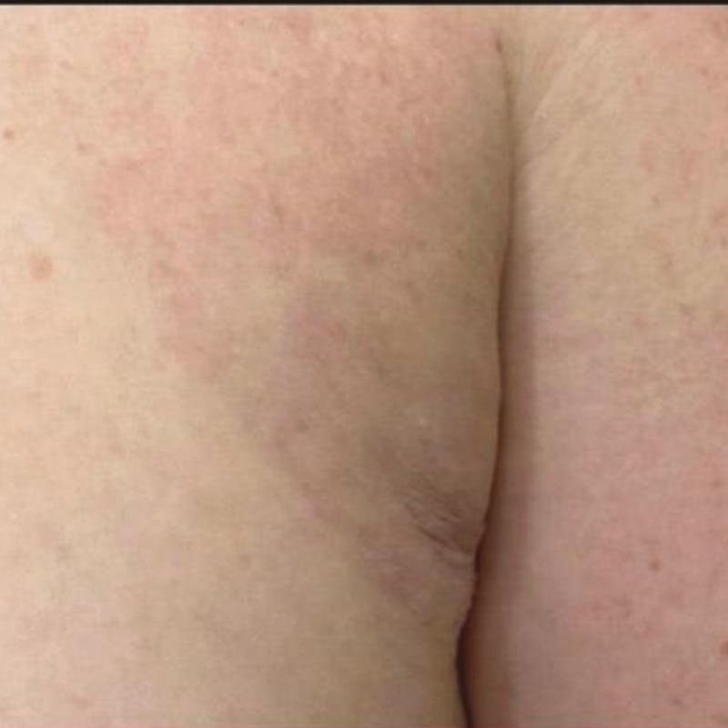 Junera Before & After Gallery - Patient 243355 - Image 2