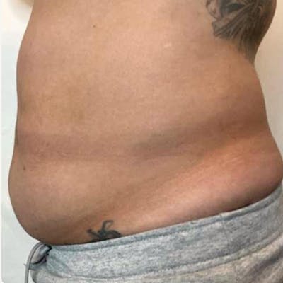 Junera Before & After Gallery - Patient 412691 - Image 1