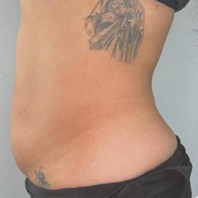 Junera Before & After Gallery - Patient 412691 - Image 2