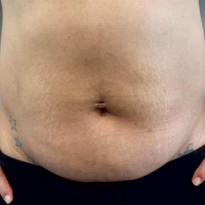 Junera Before & After Gallery - Patient 307882 - Image 1
