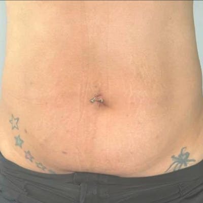 Junera Before & After Gallery - Patient 307882 - Image 2