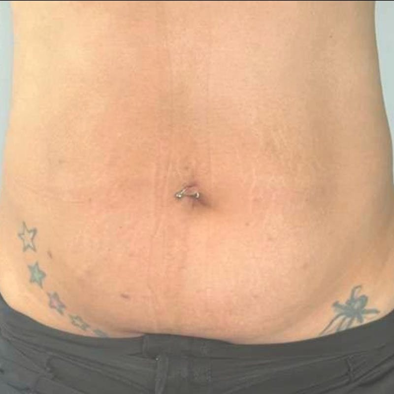 Junera Before & After Gallery - Patient 307882 - Image 2