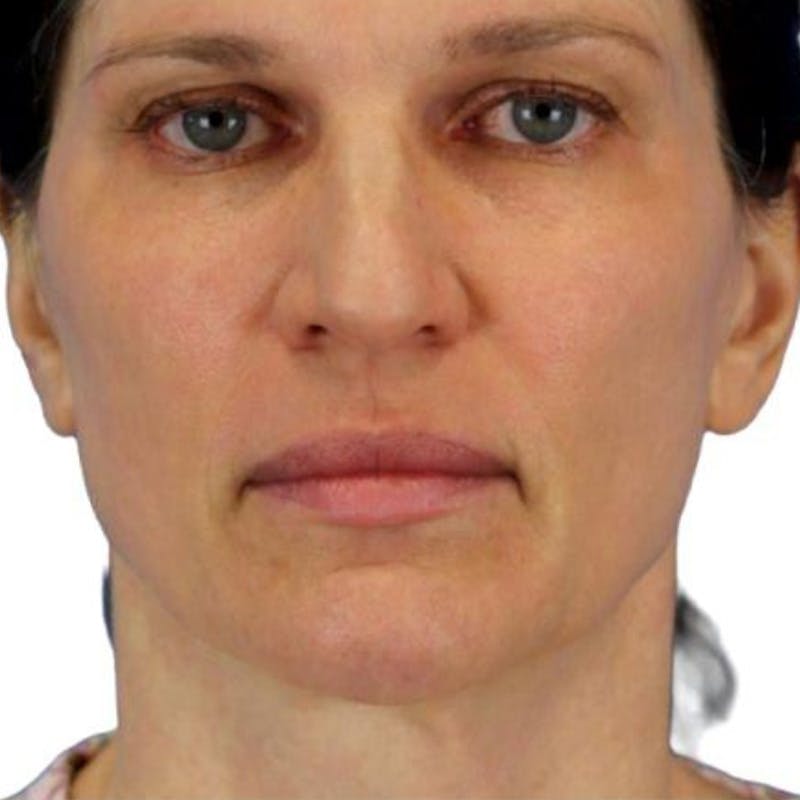 Junera Before & After Gallery - Patient 210836 - Image 1