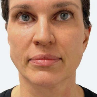 Junera Before & After Gallery - Patient 210836 - Image 2