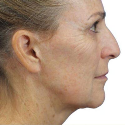 Junera Before & After Gallery - Patient 341599 - Image 1