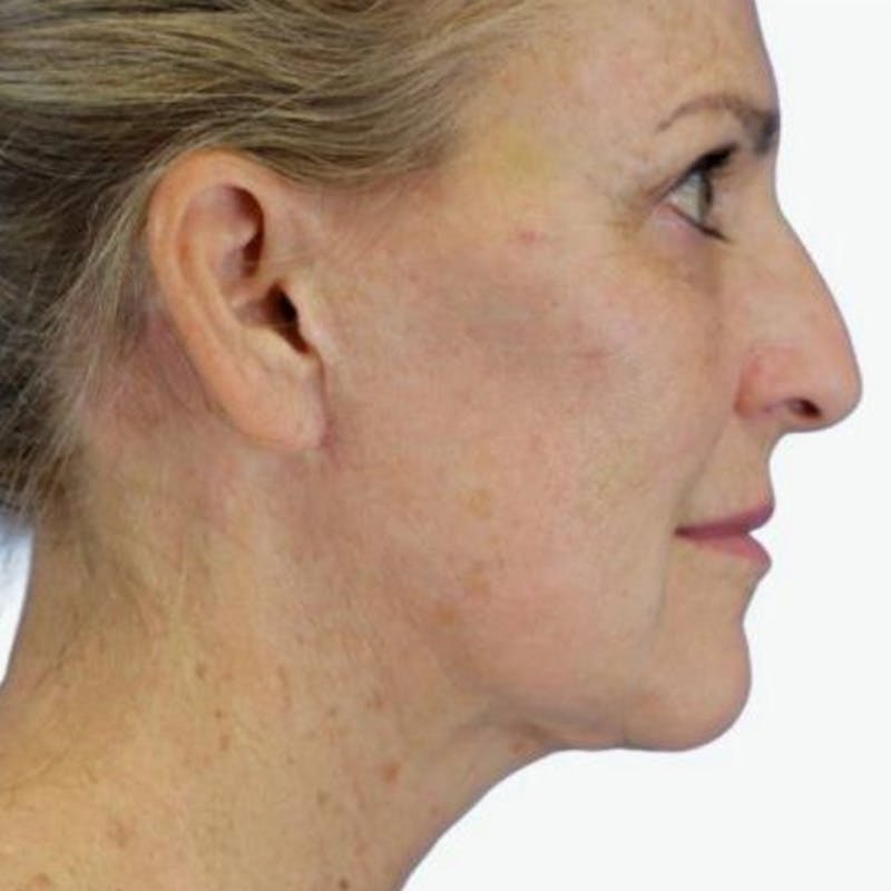 Junera Before & After Gallery - Patient 341599 - Image 2