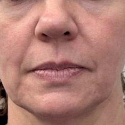 Junera Before & After Gallery - Patient 170396 - Image 1