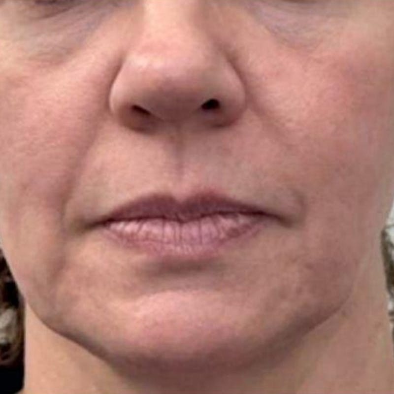 Junera Before & After Gallery - Patient 170396 - Image 1
