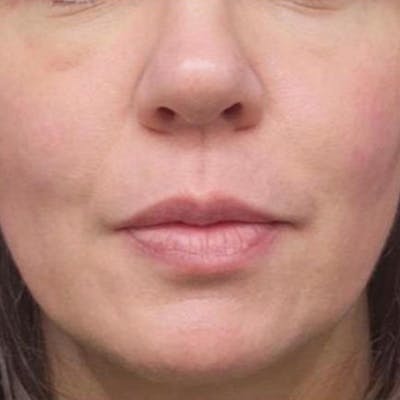 Junera Before & After Gallery - Patient 170396 - Image 2