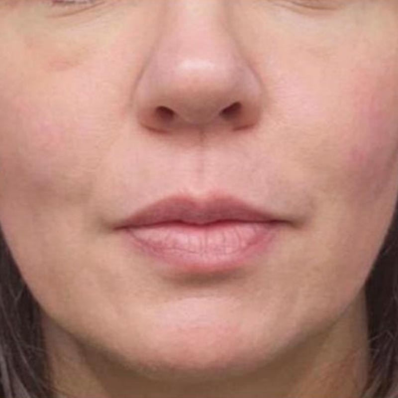 Junera Before & After Gallery - Patient 170396 - Image 2