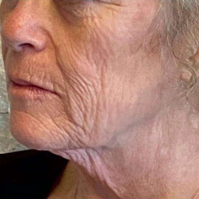 Junera Before & After Gallery - Patient 276619 - Image 1