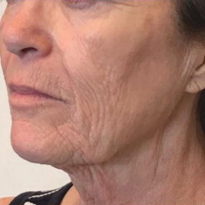 Junera Before & After Gallery - Patient 276619 - Image 2