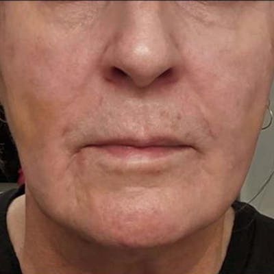 Junera Before & After Gallery - Patient 397771 - Image 2