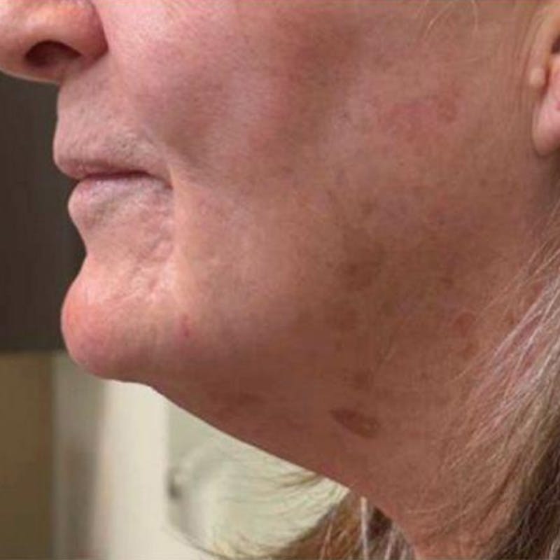 Junera Before & After Gallery - Patient 689752 - Image 1