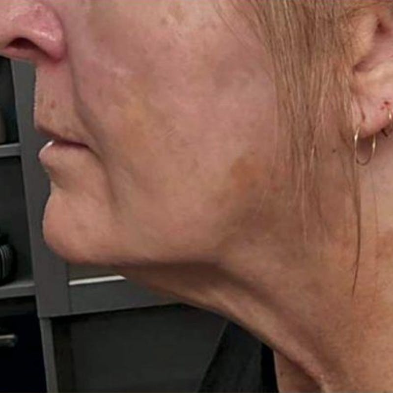 Junera Before & After Gallery - Patient 689752 - Image 2