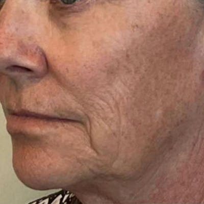 Junera Before & After Gallery - Patient 398190 - Image 1