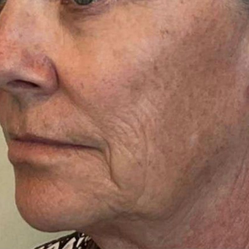 Junera Before & After Gallery - Patient 398190 - Image 1