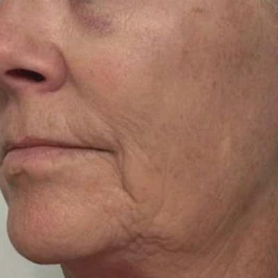 Junera Before & After Gallery - Patient 398190 - Image 2