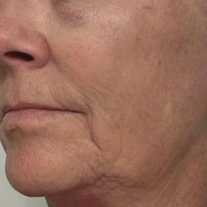 Junera Before & After Gallery - Patient 398190 - Image 2