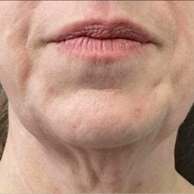 Junera Before & After Gallery - Patient 687311 - Image 1