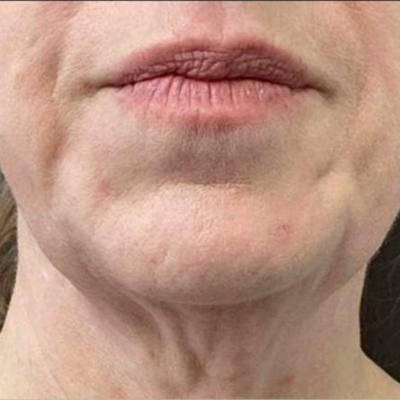 Junera Before & After Gallery - Patient 687311 - Image 1
