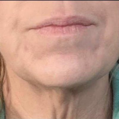 Junera Before & After Gallery - Patient 687311 - Image 2