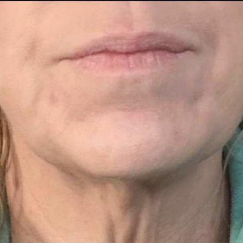 Junera Before & After Gallery - Patient 687311 - Image 2