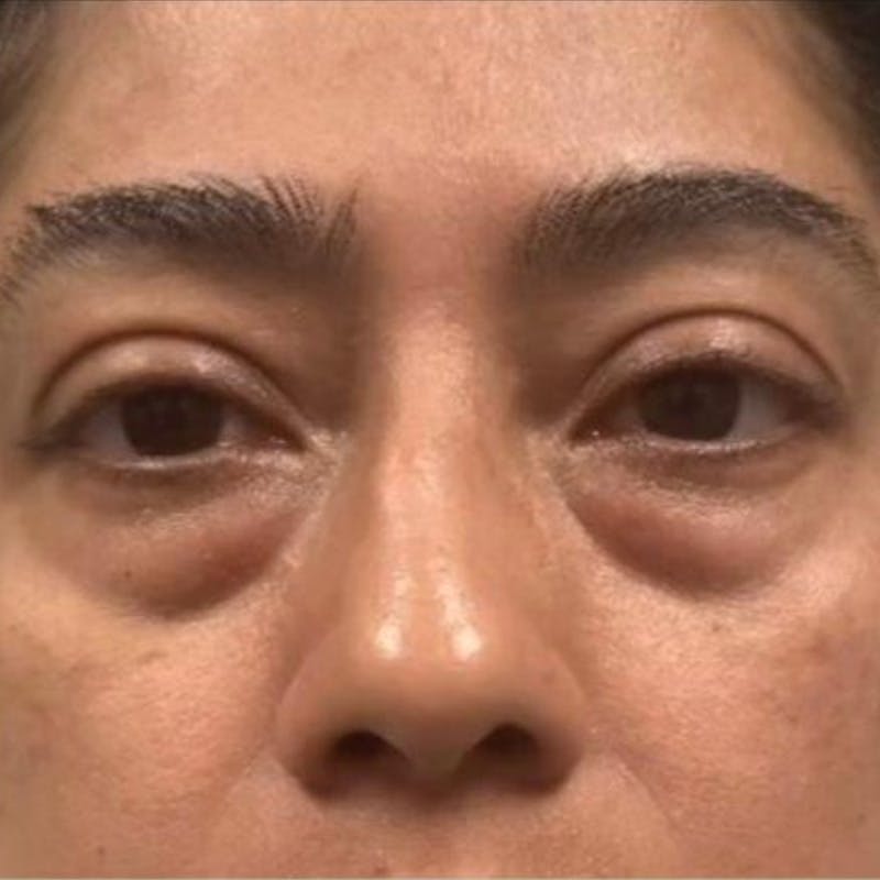 Junera Before & After Gallery - Patient 105850 - Image 1