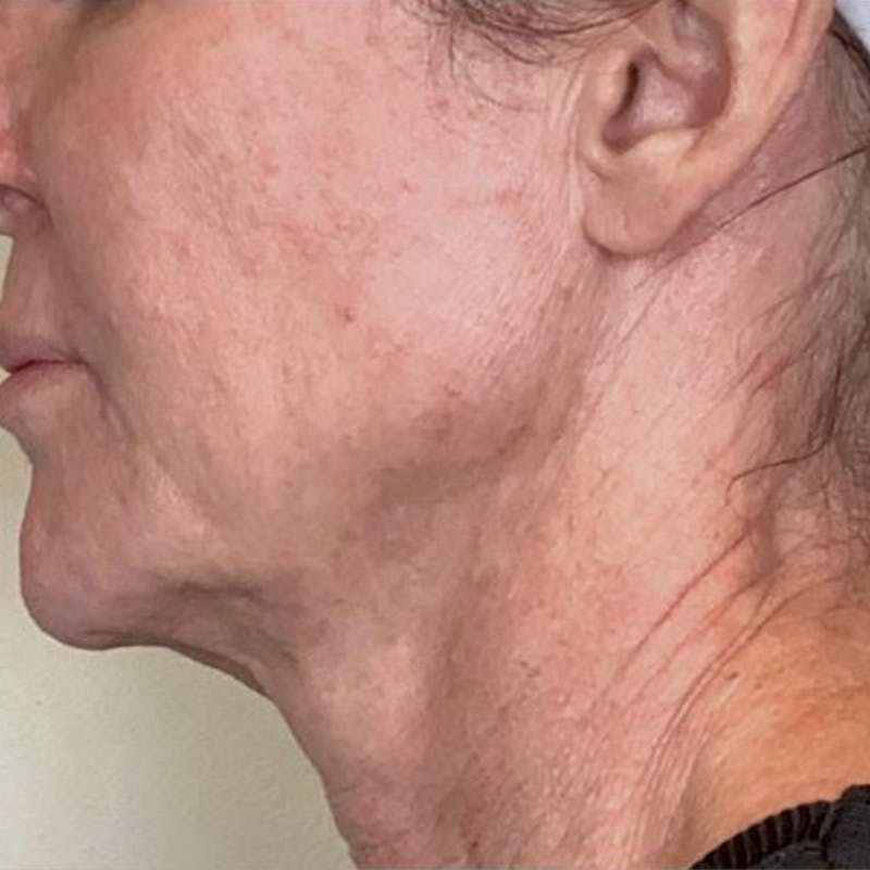 Junera Before & After Gallery - Patient 369344 - Image 1