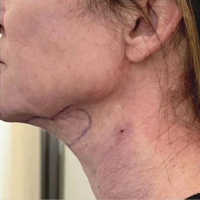 Junera Before & After Gallery - Patient 369344 - Image 2