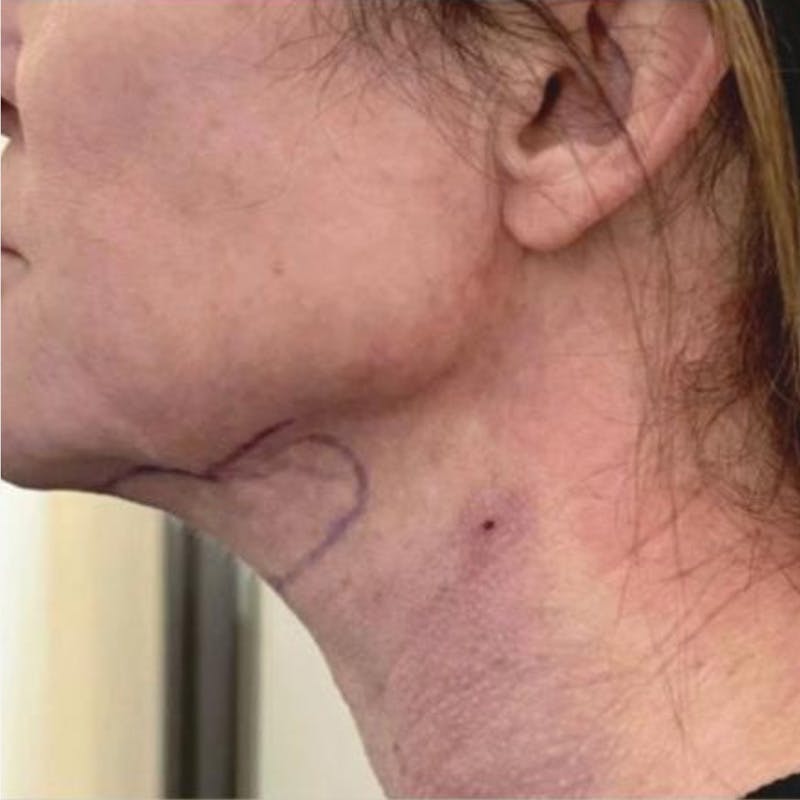 Junera Before & After Gallery - Patient 369344 - Image 2