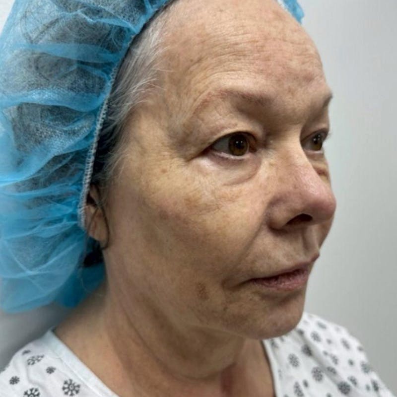 Junera Before & After Gallery - Patient 323206 - Image 1