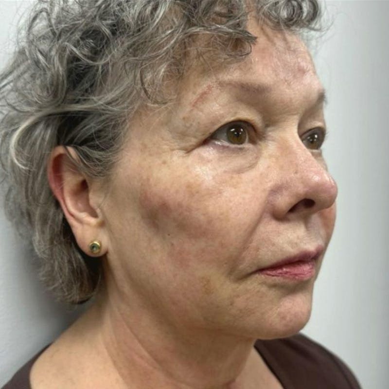 Junera Before & After Gallery - Patient 323206 - Image 2