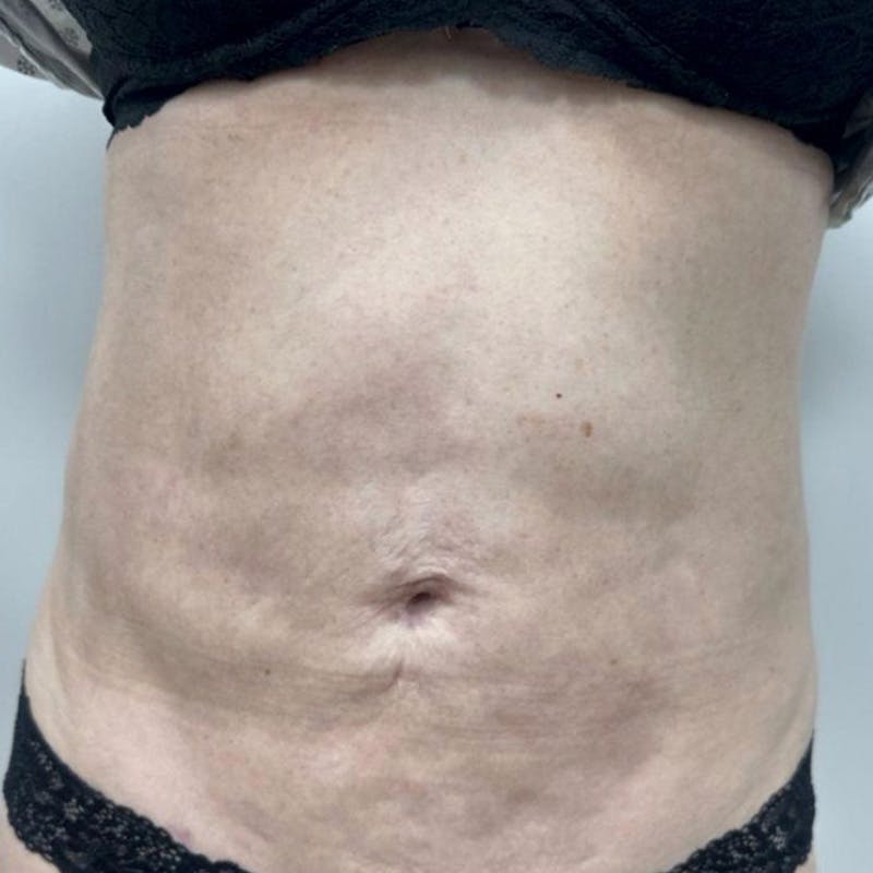 Junera Before & After Gallery - Patient 212453 - Image 1