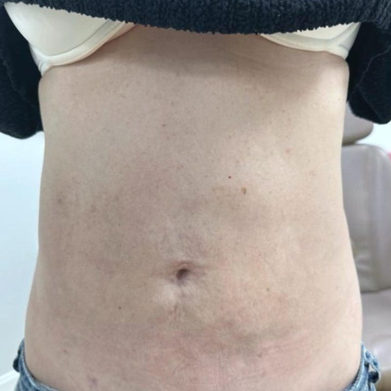 Junera Before & After Gallery - Patient 212453 - Image 2