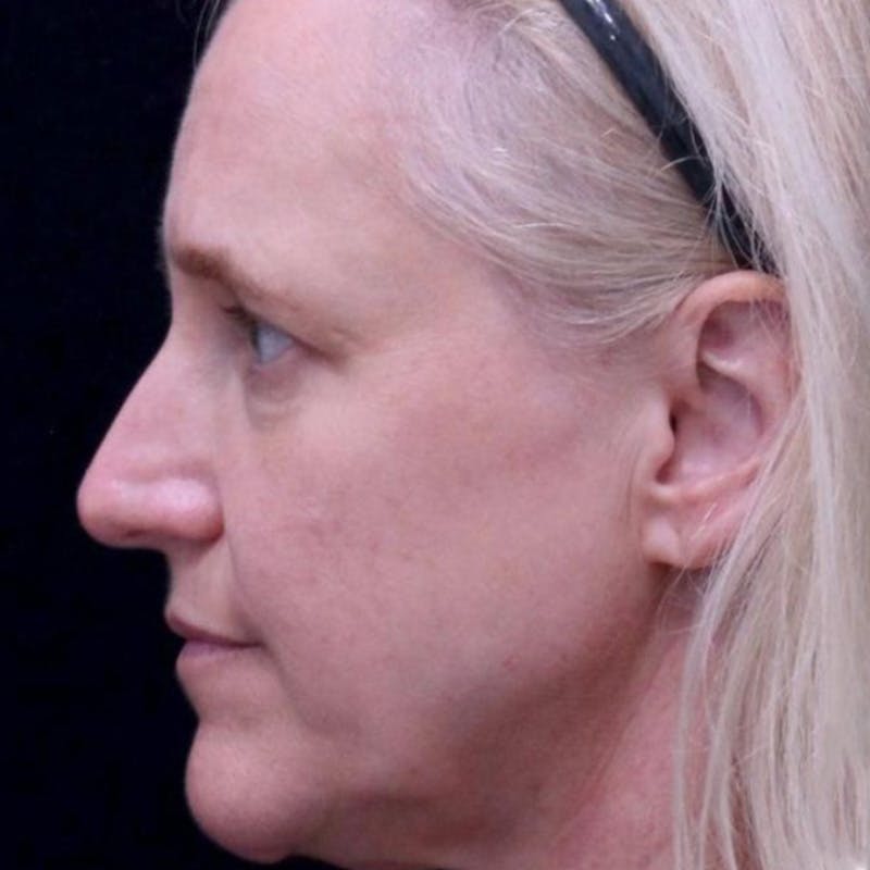 Junera Before & After Gallery - Patient 359032 - Image 1