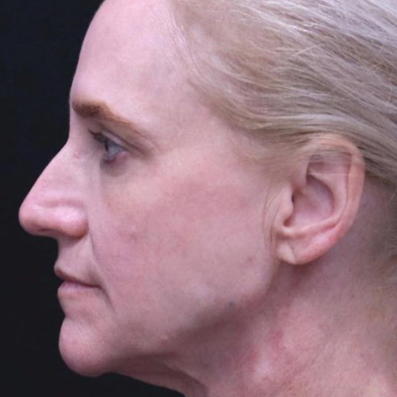 Junera Before & After Gallery - Patient 359032 - Image 2