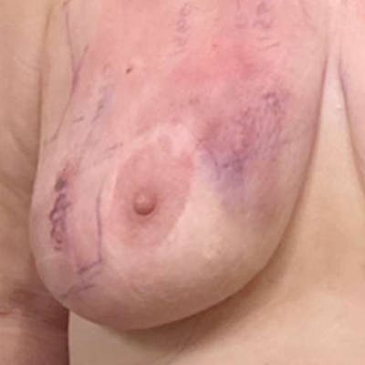 Junera Before & After Gallery - Patient 143500 - Image 2