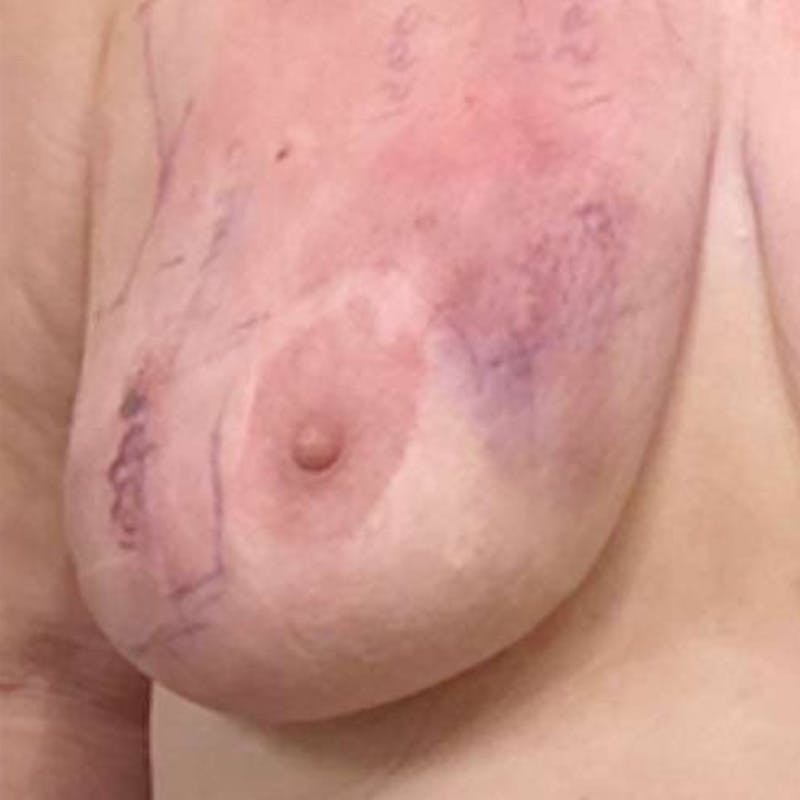 Junera Before & After Gallery - Patient 143500 - Image 2