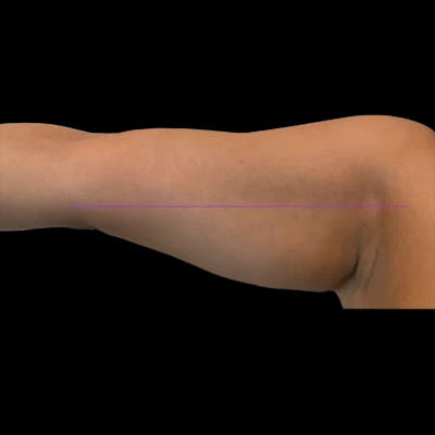 Junera Before & After Gallery - Patient 167241 - Image 1
