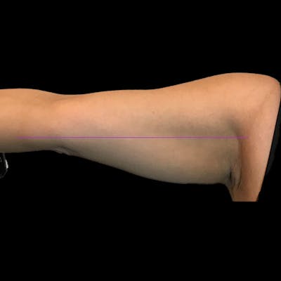 Junera Before & After Gallery - Patient 167241 - Image 2