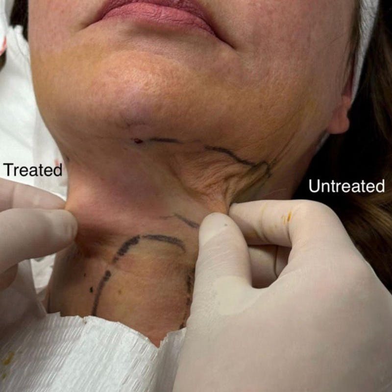 Junera Before & After Gallery - Patient 333937 - Image 2