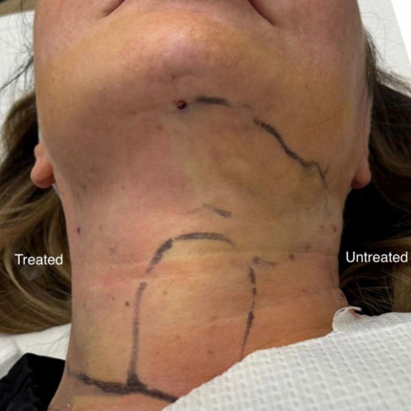 Junera Before & After Gallery - Patient 333937 - Image 1