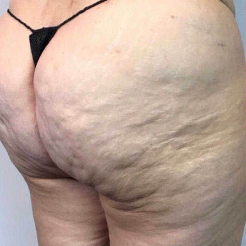 Junera Before & After Gallery - Patient 352281 - Image 1