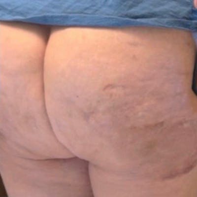 Junera Before & After Gallery - Patient 352281 - Image 2