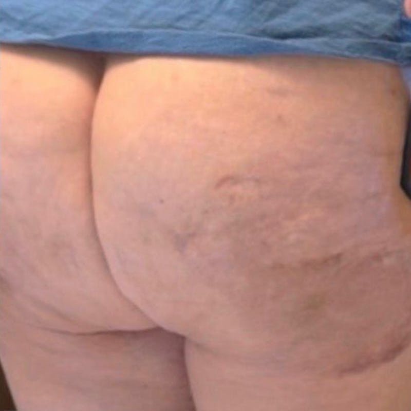 Junera Before & After Gallery - Patient 352281 - Image 2