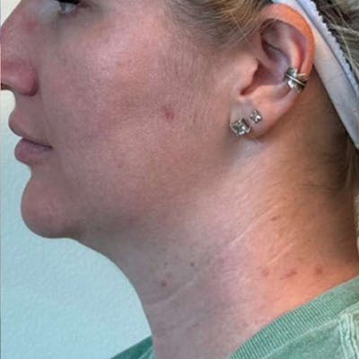 Junera Before & After Gallery - Patient 250871 - Image 1