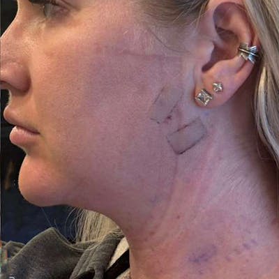 Junera Before & After Gallery - Patient 250871 - Image 2